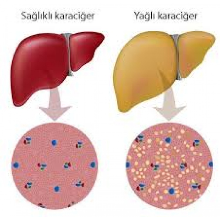 Karaciğer Yağlanması (Hepatik Steatoz)